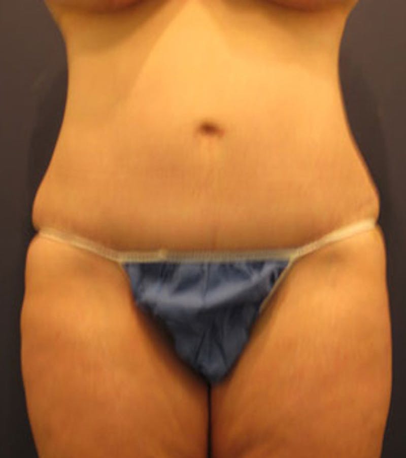 Mommy Makeover Before & After Gallery - Patient 174163303 - Image 2