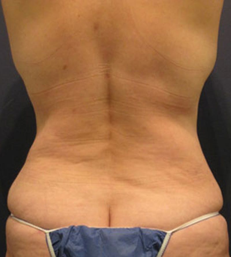 Mommy Makeover Before & After Gallery - Patient 174163303 - Image 4