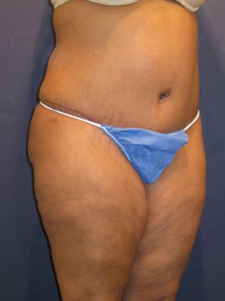 Mommy Makeover Before & After Gallery - Patient 174163312 - Image 6