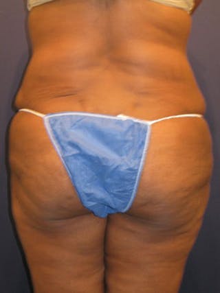 Mommy Makeover Before & After Gallery - Patient 174163312 - Image 8