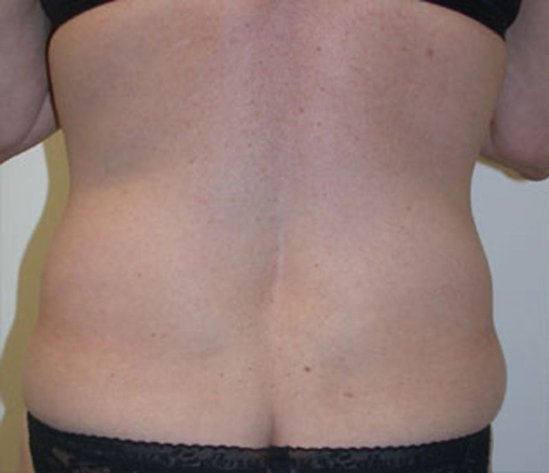 Mommy Makeover Before & After Gallery - Patient 174163319 - Image 3