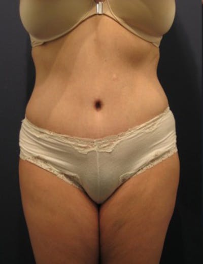 Mommy Makeover Before & After Gallery - Patient 174164420 - Image 1