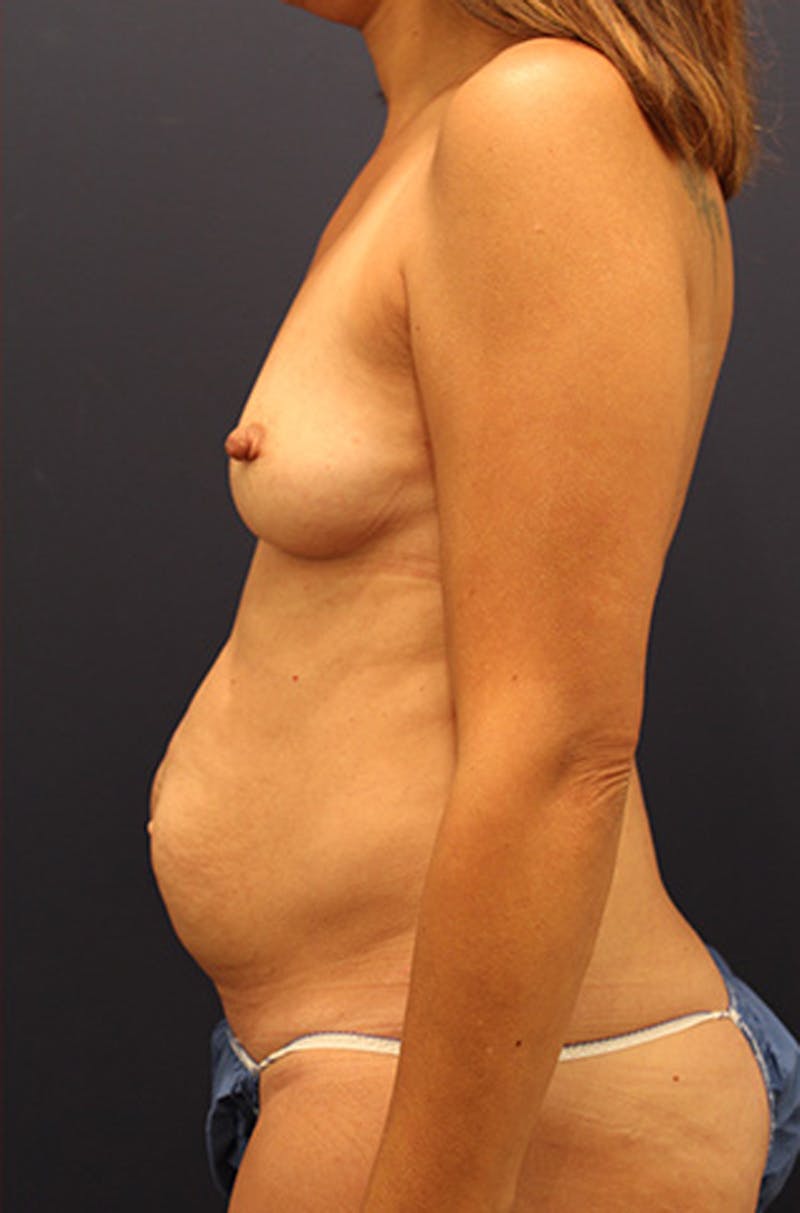 Mommy Makeover Before & After Gallery - Patient 174164445 - Image 5
