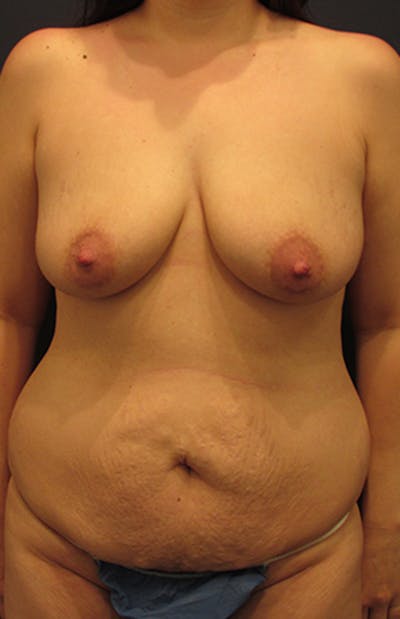 Mommy Makeover Before & After Gallery - Patient 174164467 - Image 1