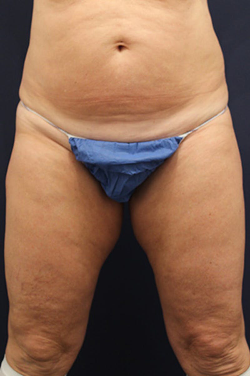Thigh Lift Before & After Gallery - Patient 174162072 - Image 1