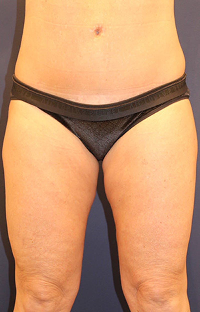 Thigh Lift Before & After Gallery - Patient 174162072 - Image 2
