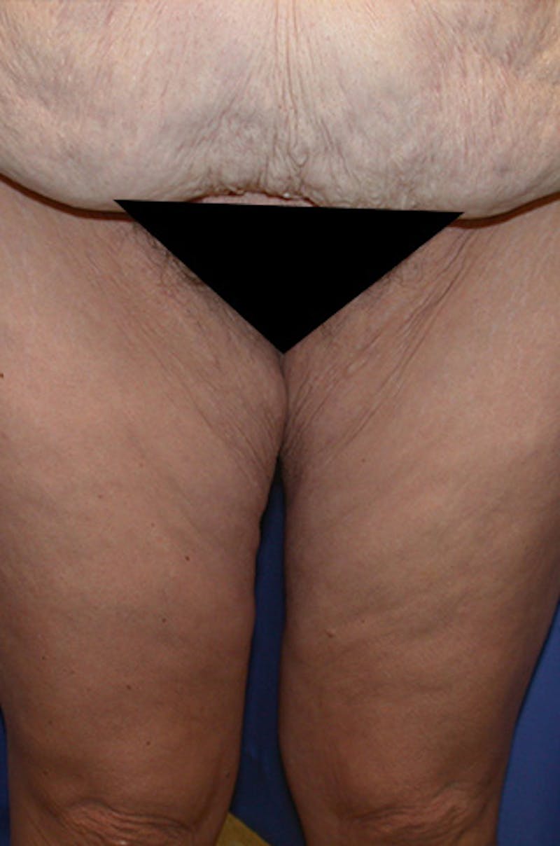Thigh Lift Before & After Gallery - Patient 174162078 - Image 1