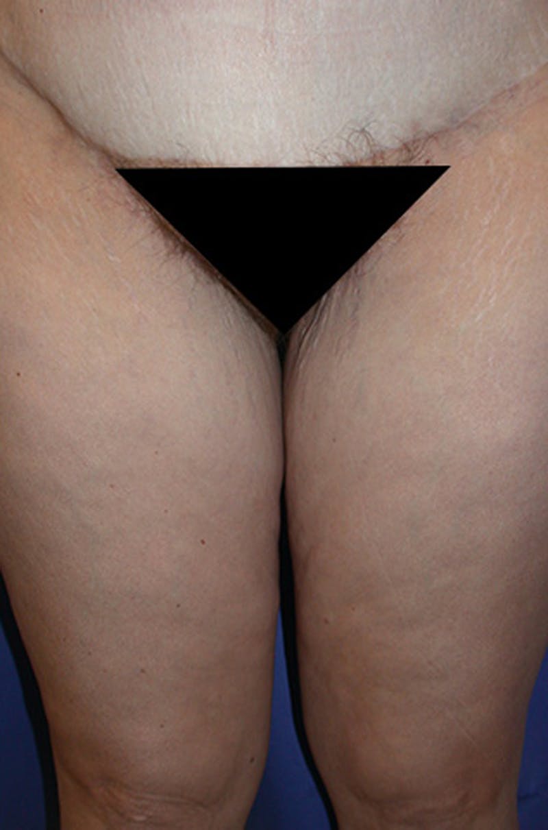 Thigh Lift Before & After Gallery - Patient 174162078 - Image 2
