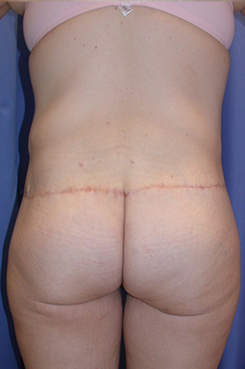 Thigh Lift Before & After Gallery - Patient 174163156 - Image 2