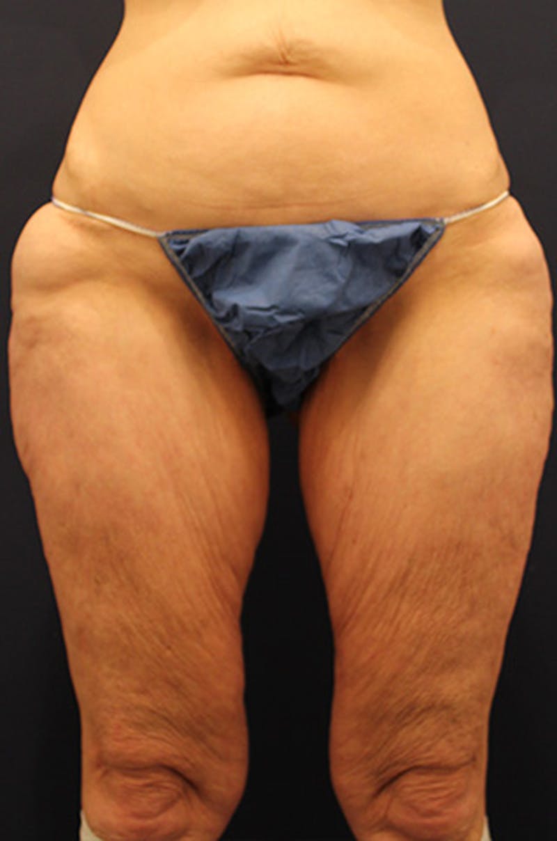 Thigh Lift Before & After Gallery - Patient 174163160 - Image 1