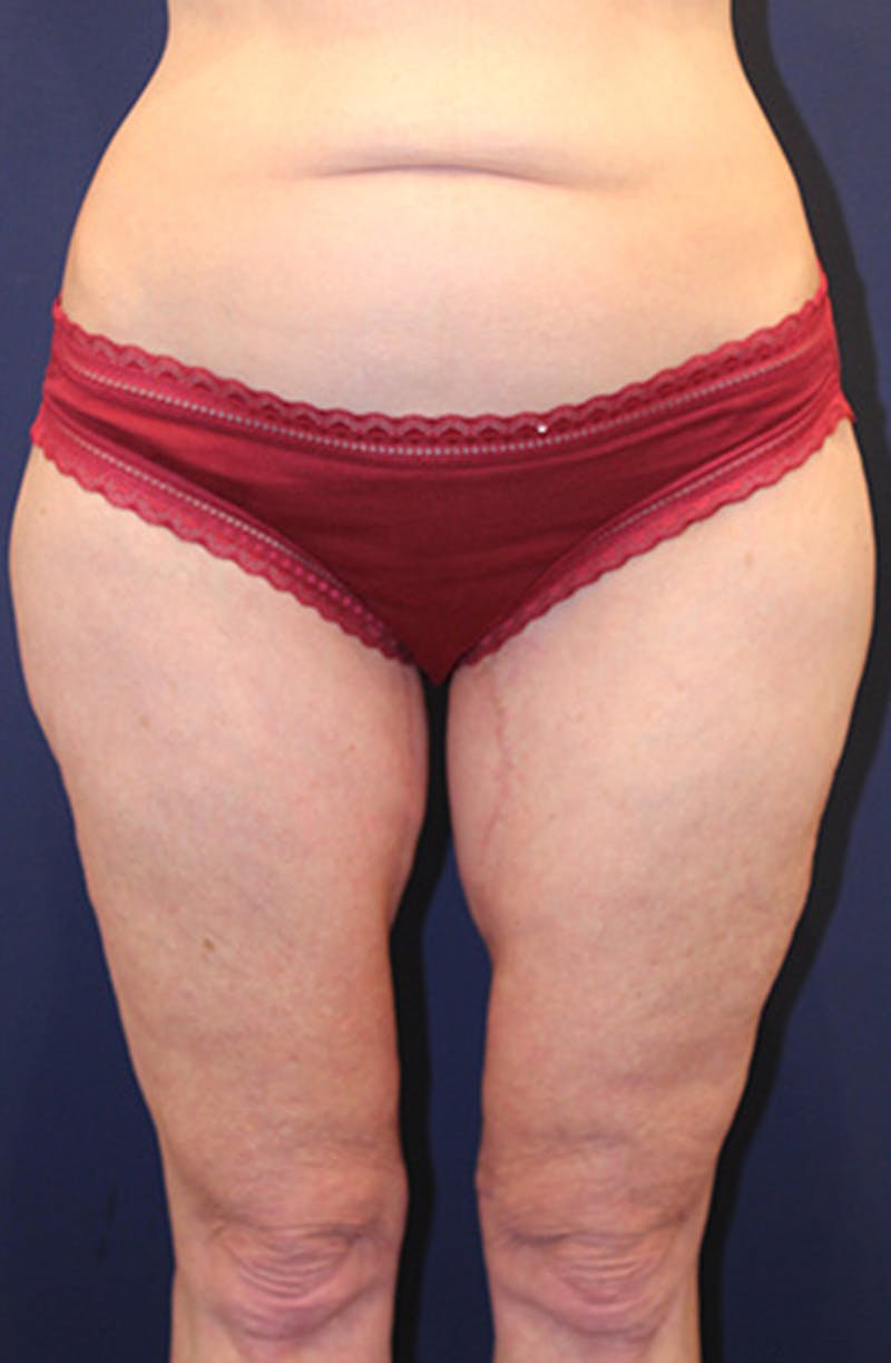 Thigh Lift Before & After Gallery - Patient 174163160 - Image 2