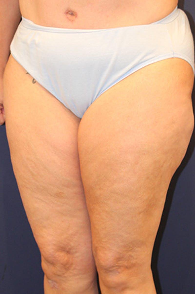 Thigh Lift Before & After Gallery - Patient 174163167 - Image 1
