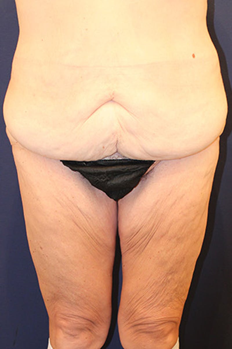 Thigh Lift Before & After Gallery - Patient 174163175 - Image 1