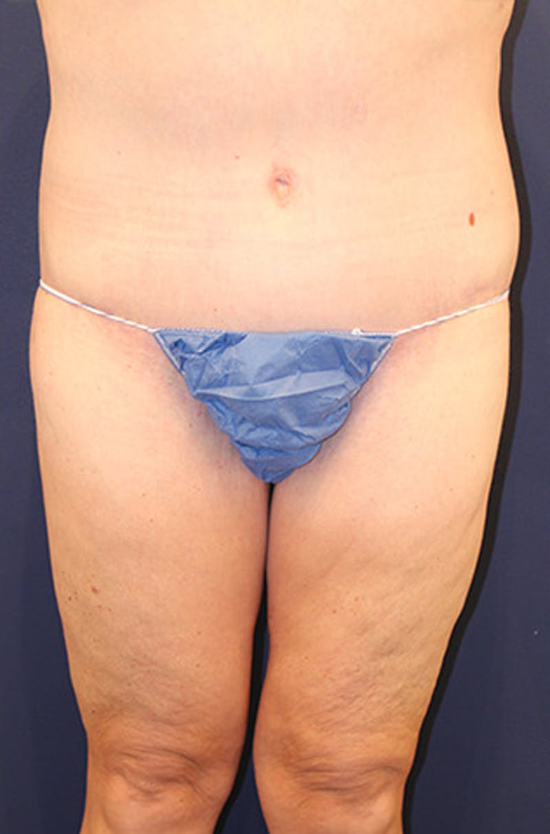 Thigh Lift Before & After Gallery - Patient 174163175 - Image 2