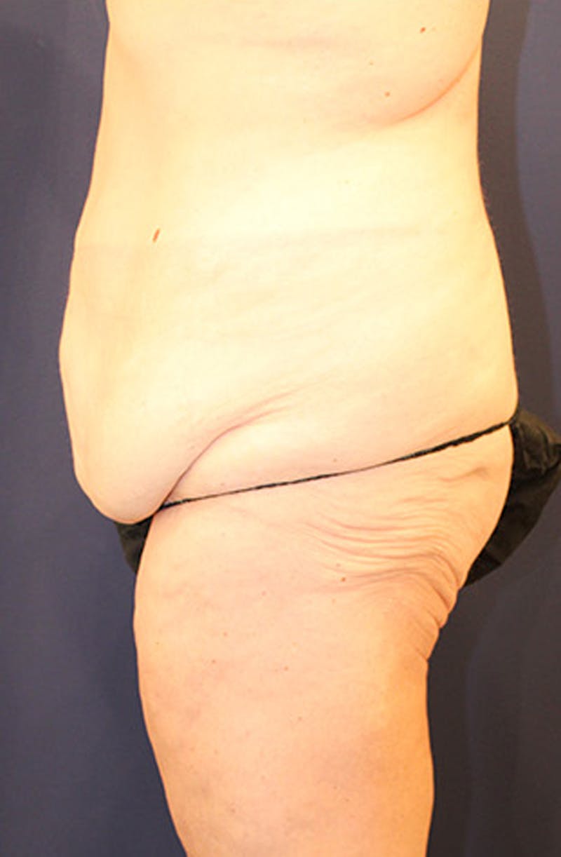 Thigh Lift Before & After Gallery - Patient 174163175 - Image 3