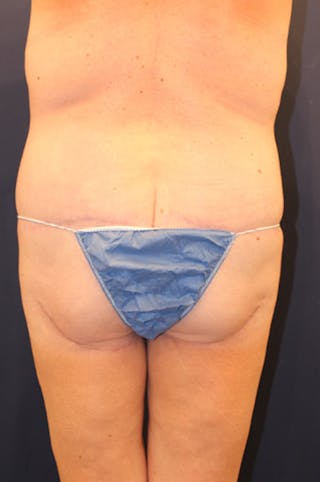 Thigh Lift Before & After Gallery - Patient 174163175 - Image 6