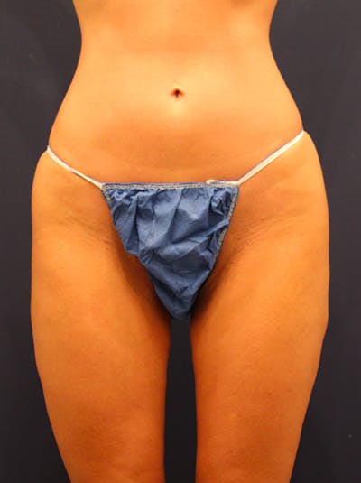 Thigh Lift Before & After Gallery - Patient 174163181 - Image 1
