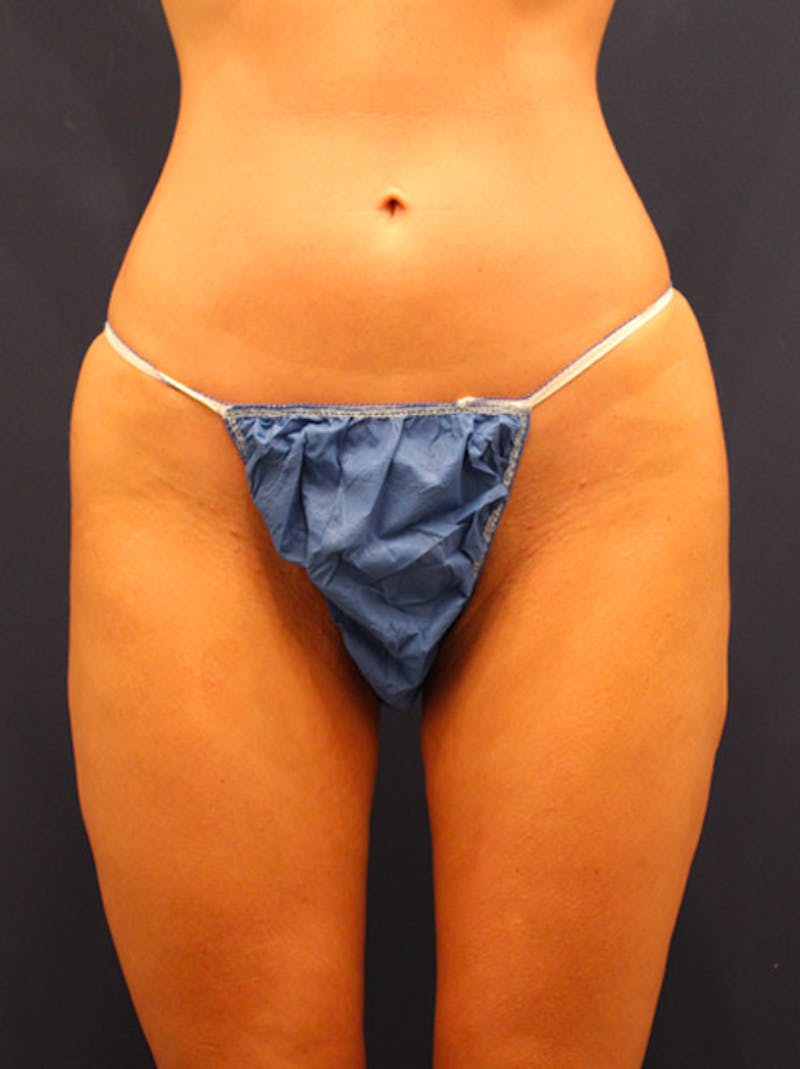 Thigh Lift Before & After Gallery - Patient 174163181 - Image 1