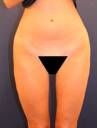 Thigh Lift Before & After Gallery - Patient 174163181 - Image 2