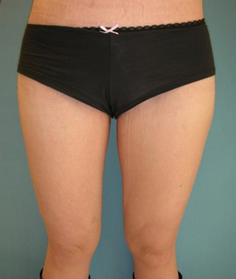 Thigh Lift Before & After Gallery - Patient 174163186 - Image 2