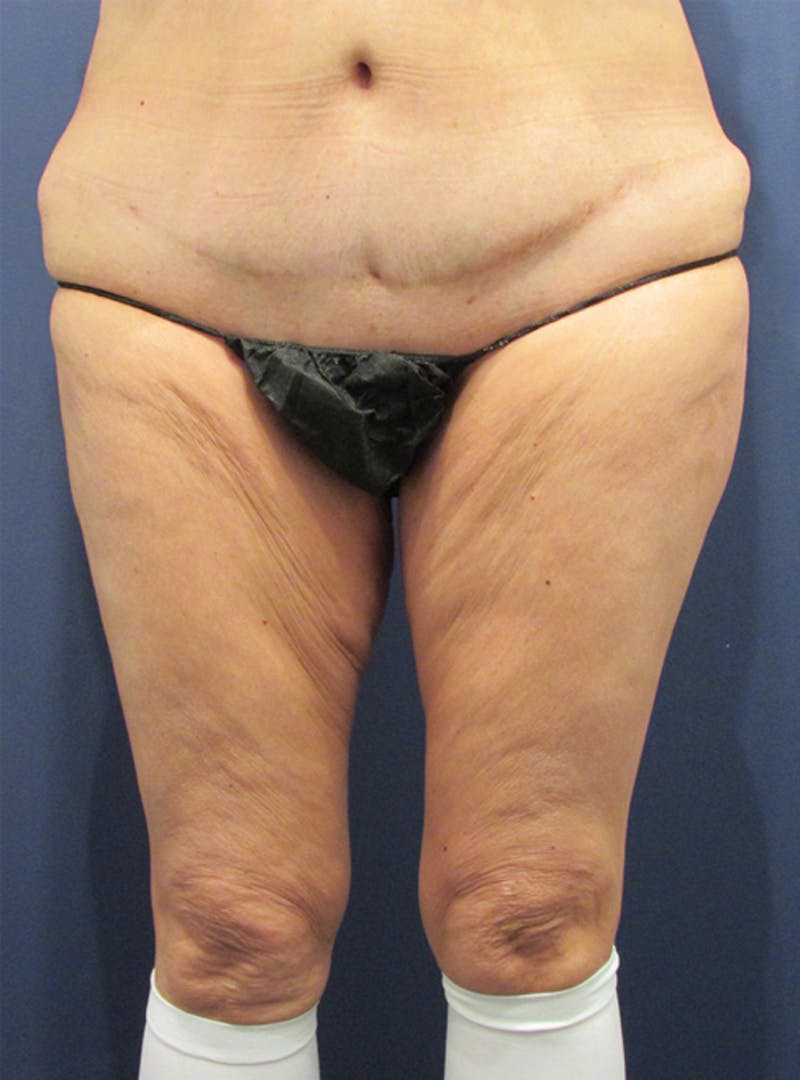 Thigh Lift Before & After Gallery - Patient 174163196 - Image 1