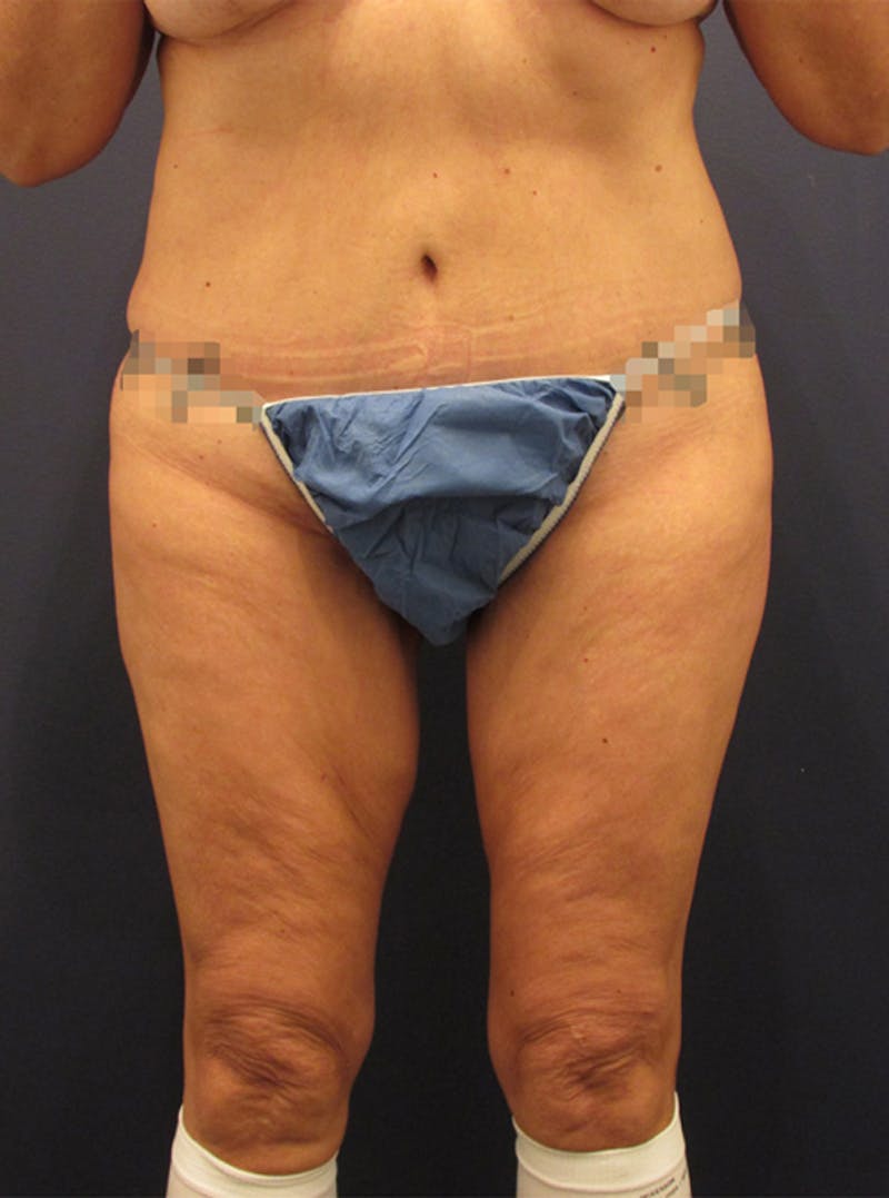 Thigh Lift Before & After Gallery - Patient 174163196 - Image 2