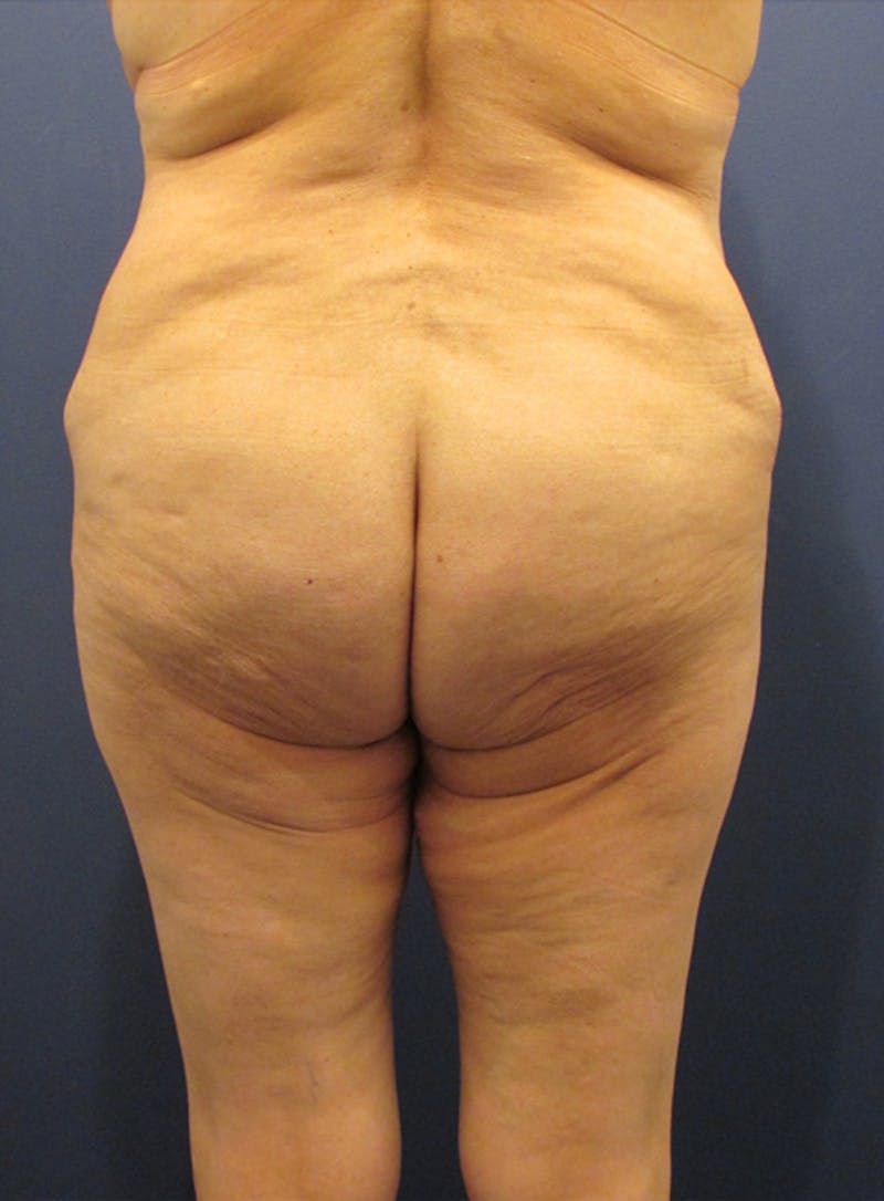 Thigh Lift Before & After Gallery - Patient 174163196 - Image 3