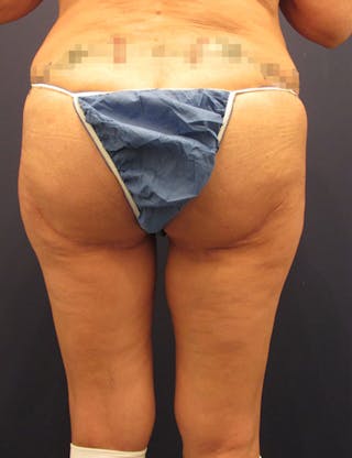 Thigh Lift Before & After Gallery - Patient 174163196 - Image 4