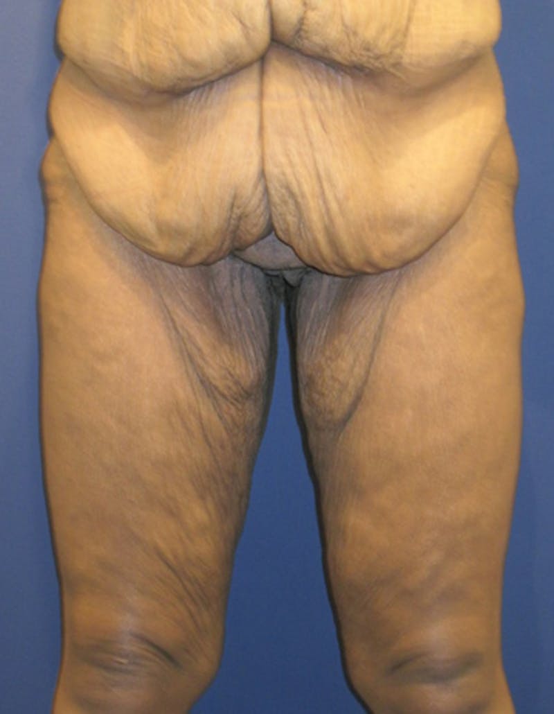 Thigh Lift Before & After Gallery - Patient 174163202 - Image 1
