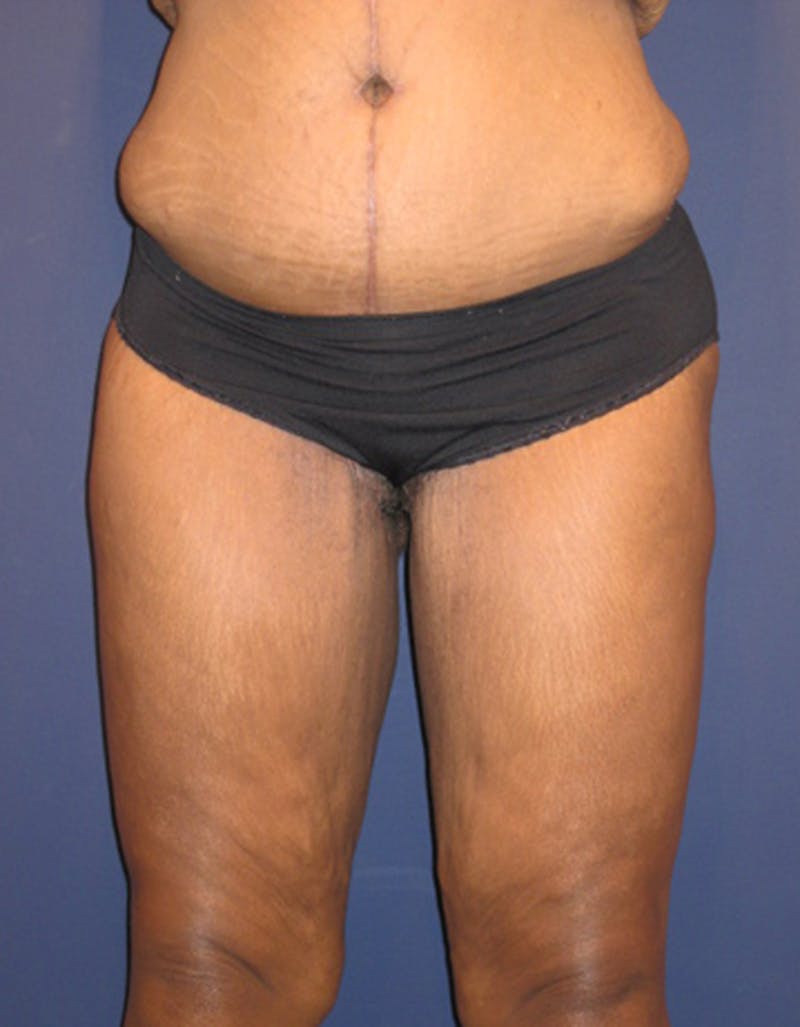 Thigh Lift Before & After Gallery - Patient 174163202 - Image 2