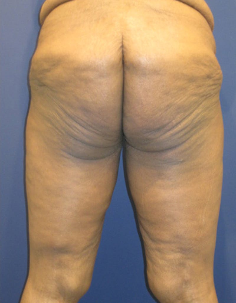 Thigh Lift Before & After Gallery - Patient 174163202 - Image 3