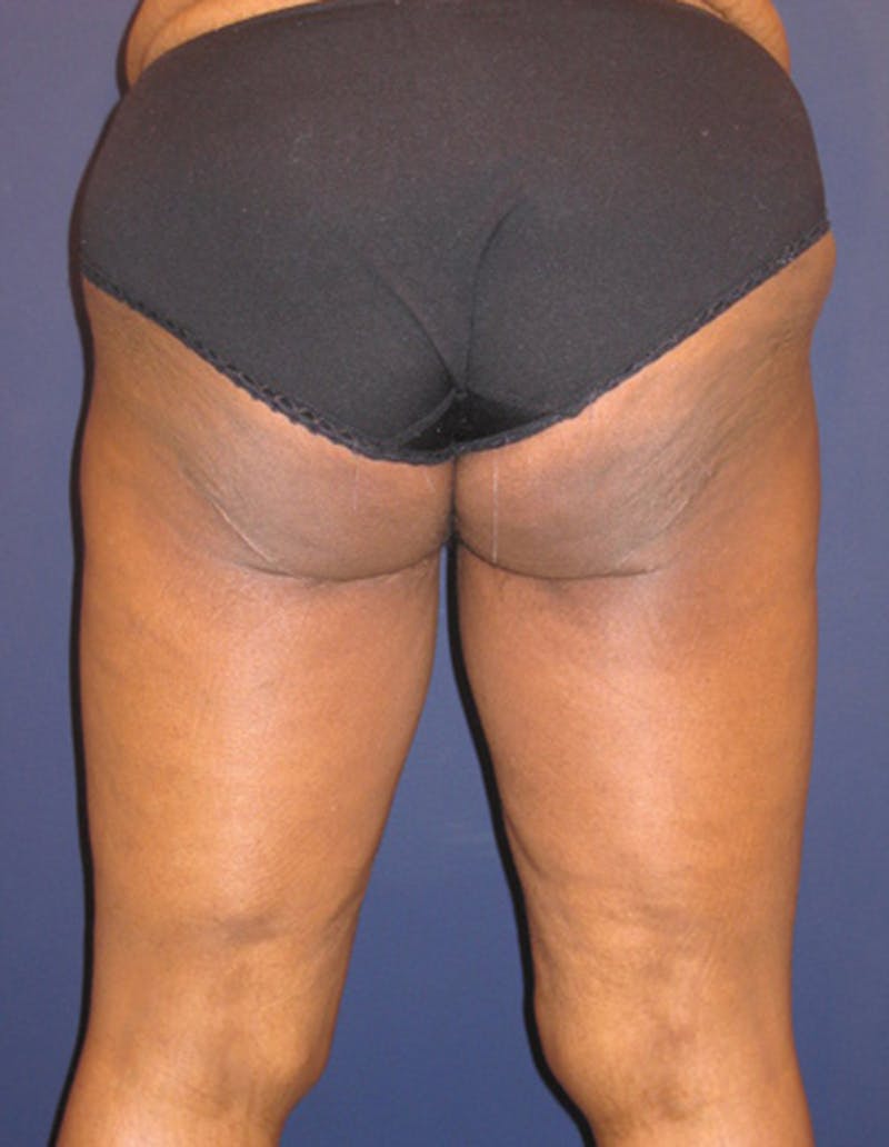 Thigh Lift Before & After Gallery - Patient 174163202 - Image 4