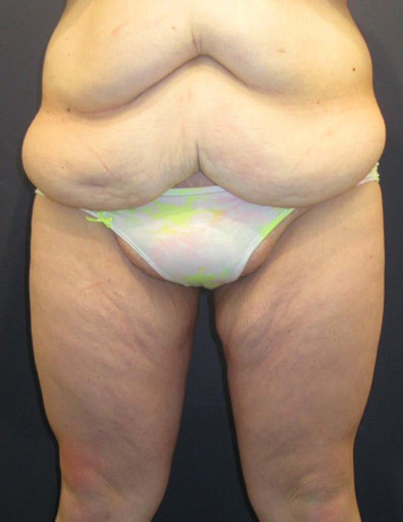 Thigh Lift Before & After Gallery - Patient 174163210 - Image 1