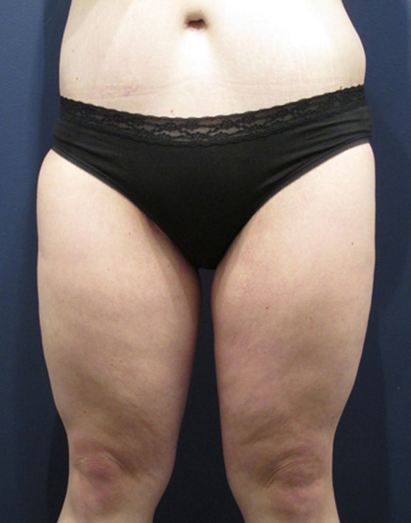 Thigh Lift Before & After Gallery - Patient 174163210 - Image 2