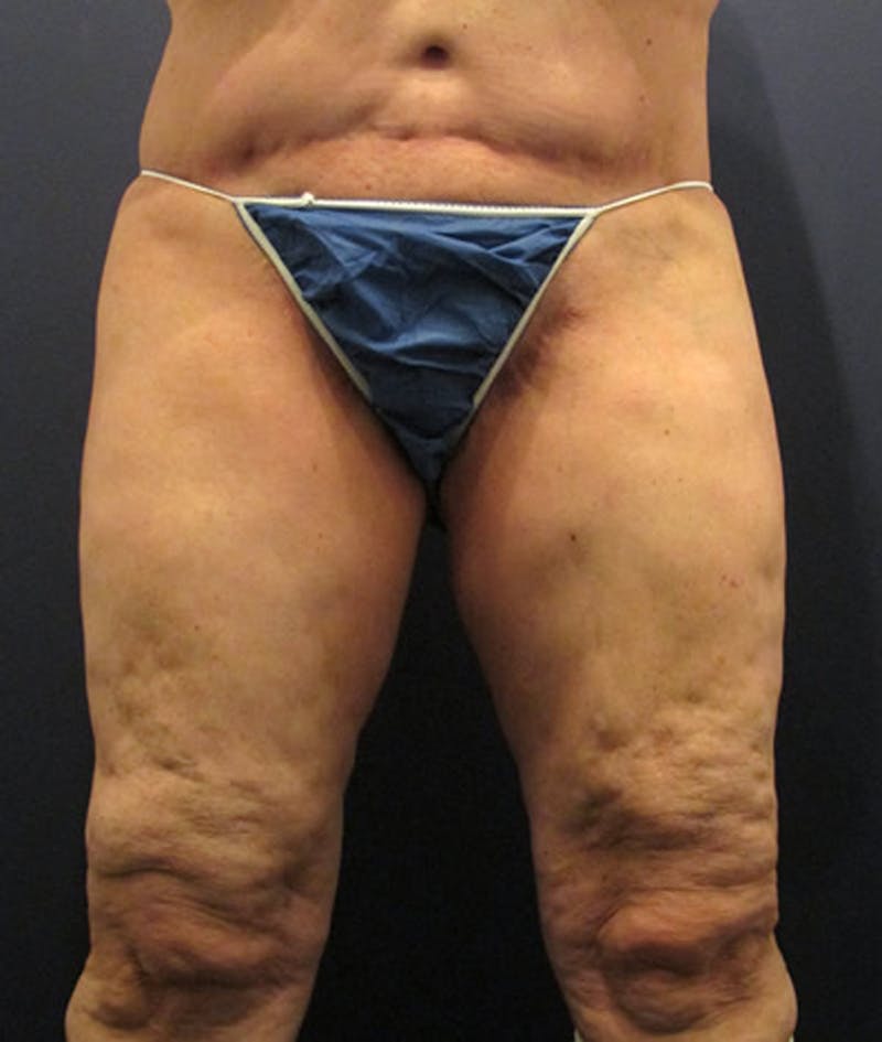 Thigh Lift Before & After Gallery - Patient 174163219 - Image 1