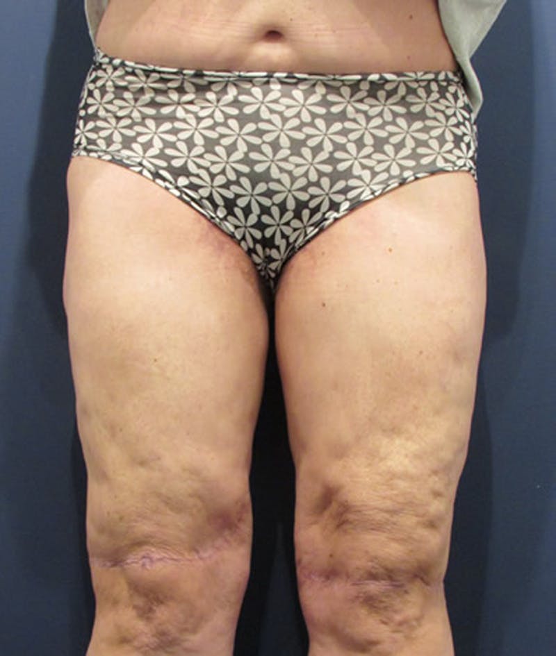 Thigh Lift Before & After Gallery - Patient 174163219 - Image 2