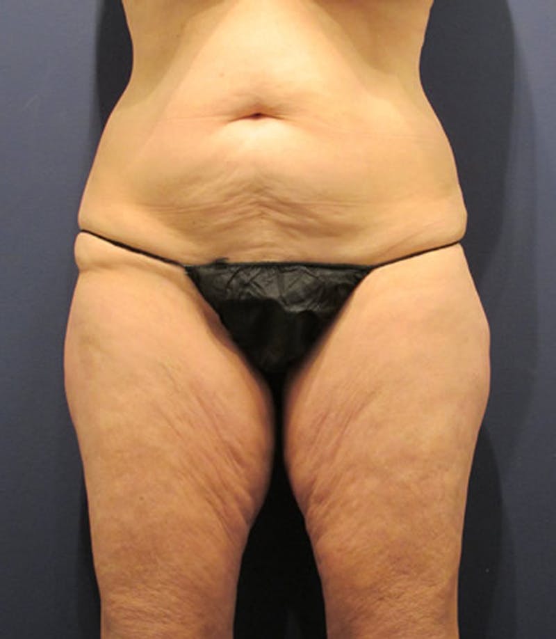 Thigh Lift Before & After Gallery - Patient 174163228 - Image 1