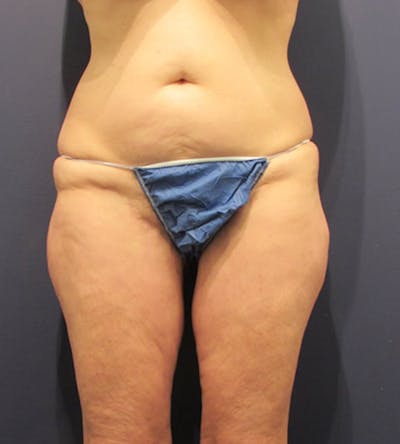 Thigh Lift Before & After Gallery - Patient 174163228 - Image 2