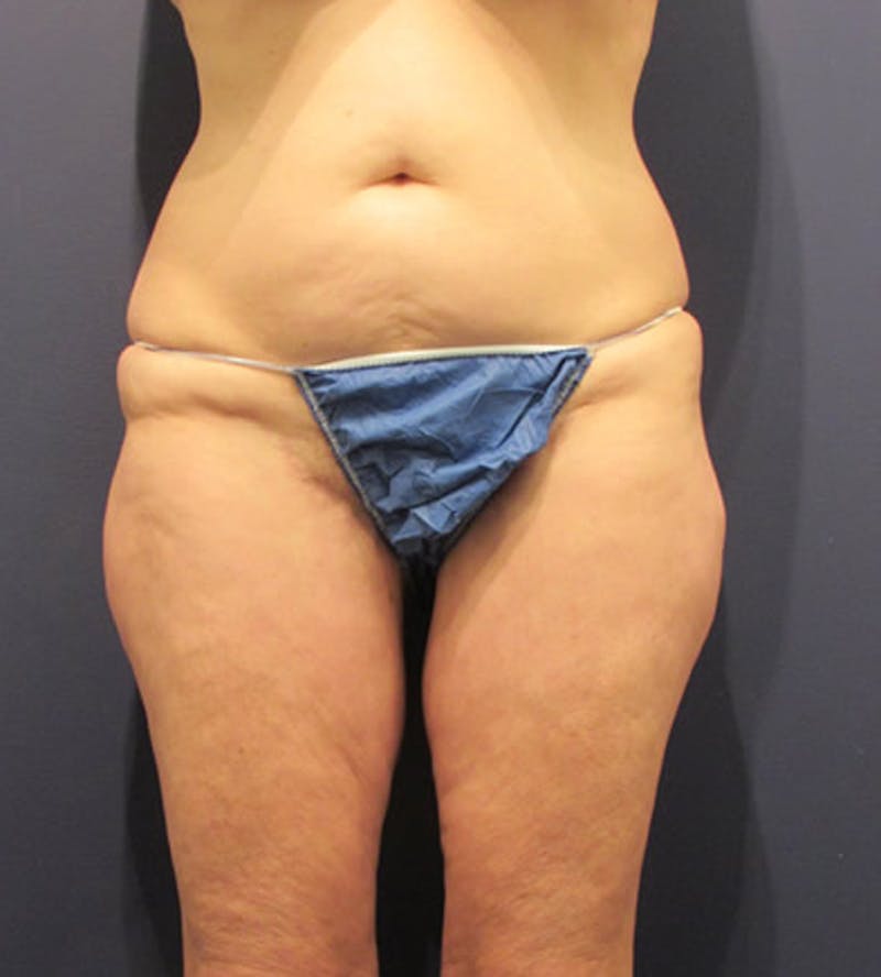 Thigh Lift Before & After Gallery - Patient 174163228 - Image 2