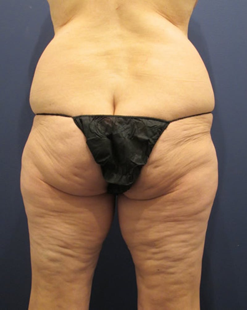 Thigh Lift Before & After Gallery - Patient 174163228 - Image 3