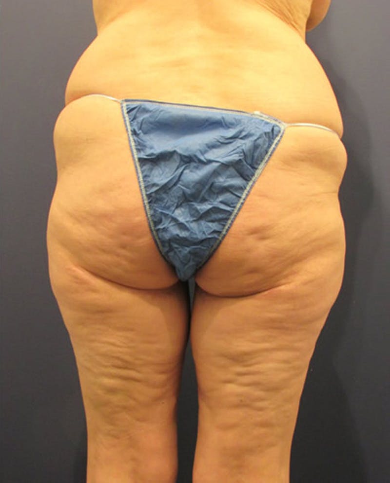 Thigh Lift Before & After Gallery - Patient 174163228 - Image 4