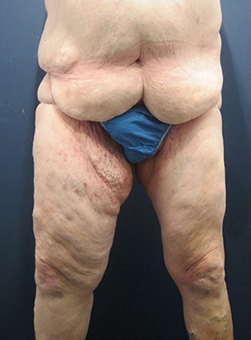 Thigh Lift Before & After Gallery - Patient 174163239 - Image 1