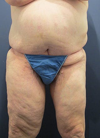 Thigh Lift Before & After Gallery - Patient 174163239 - Image 2