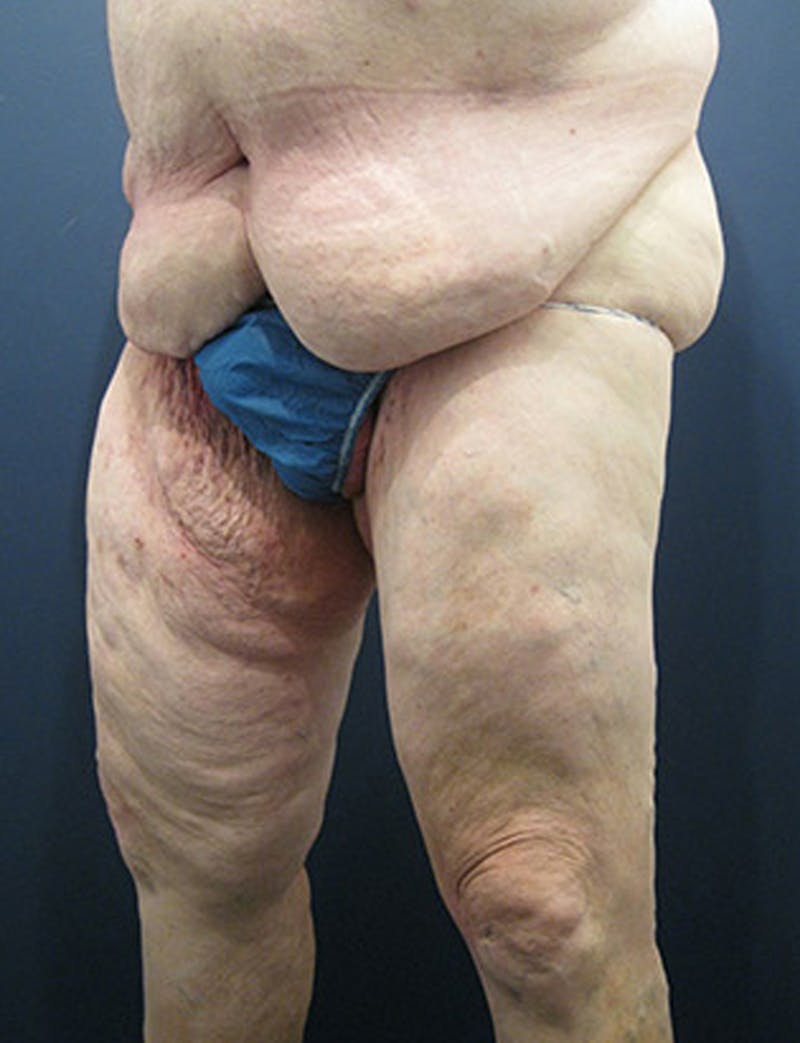 Thigh Lift Before & After Gallery - Patient 174163239 - Image 3