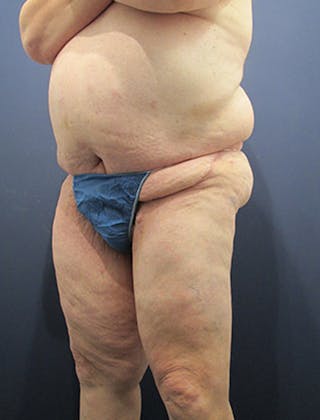 Thigh Lift Before & After Gallery - Patient 174163239 - Image 4