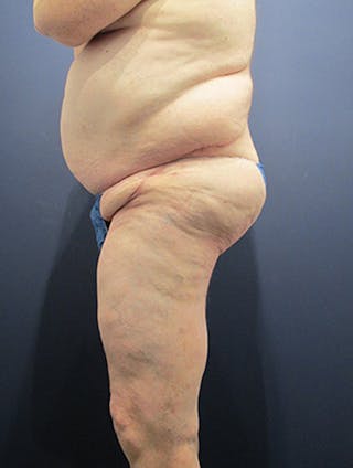 Thigh Lift Before & After Gallery - Patient 174163239 - Image 6