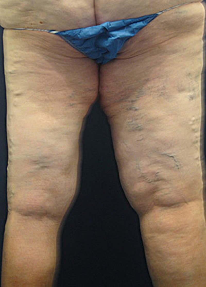 Thigh Lift Before & After Gallery - Patient 174163239 - Image 7