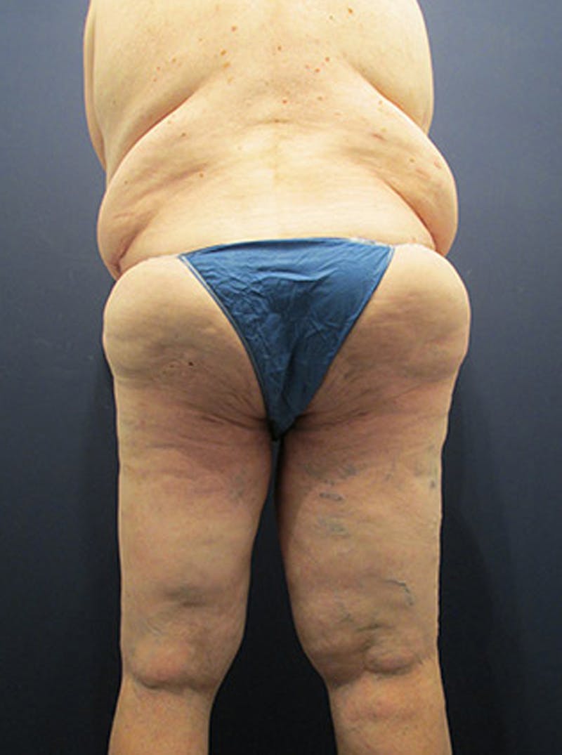 Thigh Lift Before & After Gallery - Patient 174163239 - Image 8