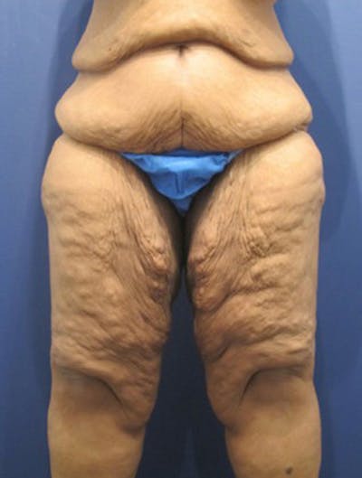 Thigh Lift Before & After Gallery - Patient 174163245 - Image 1