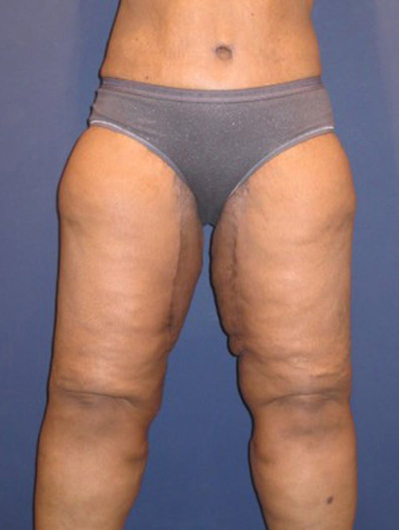 Thigh Lift Before & After Gallery - Patient 174163245 - Image 2
